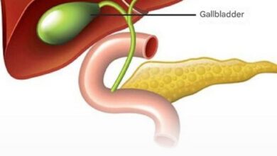 What to Expect After Gallbladder Surgery: Side Effects and Dietary Tips