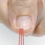 Vertical Nail Ridges: Normal Changes and Nail Health