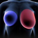 Breast ċãnċêr: 4 Early Warning Signs Every Woman Shouldn’t Ignore