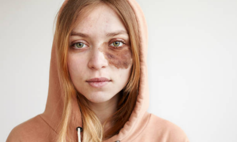 A Girl Mocked My Daughter’s Birthmark in Front of the Whole School—Then One Boy Took the Microphone A Girl Mocked My Daughter’s Birthmark in Front of the Whole School—Then One Boy Took the Microphone